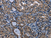 The image on the left is immunohistochemistry of paraffin-embedded Human thyroid cancer tissue using CSB-PA037727(TRPV1 Antibody) at dilution 1/20, on the right is treated with synthetic peptide. (Original magnification: ×200)