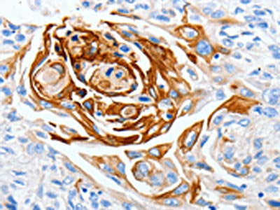 The image on the left is immunohistochemistry of paraffin-embedded Human esophagus cancer tissue using CSB-PA037833(LPAR4 Antibody) at dilution 1/30, on the right is treated with synthetic peptide. (Original magnification: ×200)