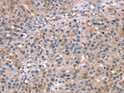 The image on the left is immunohistochemistry of paraffin-embedded Human lung cancer tissue using CSB-PA037845(MAPK3 Antibody) at dilution 1/15, on the right is treated with synthetic peptide. (Original magnification: ×200)