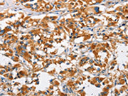 The image on the left is immunohistochemistry of paraffin-embedded Human thyroid cancer tissue using CSB-PA037884(DKK3 Antibody) at dilution 1/50, on the right is treated with fusion protein. (Original magnification: ×200)