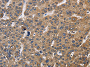 The image on the left is immunohistochemistry of paraffin-embedded Human liver cancer tissue using CSB-PA037904(SDCCAG3 Antibody) at dilution 1/30, on the right is treated with fusion protein. (Original magnification: ×200)