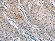The image on the left is immunohistochemistry of paraffin-embedded Human gastic cancer tissue using CSB-PA037961(SH3GLB1 Antibody) at dilution 1/30, on the right is treated with fusion protein. (Original magnification: ×200)
