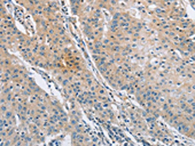 The image on the left is immunohistochemistry of paraffin-embedded Human gastic cancer tissue using CSB-PA037961(SH3GLB1 Antibody) at dilution 1/30, on the right is treated with fusion protein. (Original magnification: ×200)