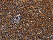 The image on the left is immunohistochemistry of paraffin-embedded Human Lymphoma tissue using CSB-PA037967(CDC34 Antibody) at dilution 1/50, on the right is treated with synthetic peptide. (Original magnification: ×200)
