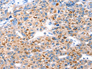 The image on the left is immunohistochemistry of paraffin-embedded Human liver cancer tissue using CSB-PA037992(GFRA3 Antibody) at dilution 1/20, on the right is treated with synthetic peptide. (Original magnification: ×200)