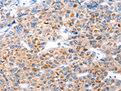The image on the left is immunohistochemistry of paraffin-embedded Human liver cancer tissue using CSB-PA037992(GFRA3 Antibody) at dilution 1/20, on the right is treated with synthetic peptide. (Original magnification: ×200)