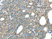 The image on the left is immunohistochemistry of paraffin-embedded Human thyroid cancer tissue using CSB-PA038075(THSD1 Antibody) at dilution 1/25, on the right is treated with fusion protein. (Original magnification: ×200)