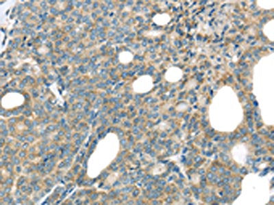 The image on the left is immunohistochemistry of paraffin-embedded Human thyroid cancer tissue using CSB-PA038075(THSD1 Antibody) at dilution 1/25, on the right is treated with fusion protein. (Original magnification: ×200)