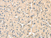 The image on the left is immunohistochemistry of paraffin-embedded Human liver cancer tissue using CSB-PA038096(LOXL3 Antibody) at dilution 1/35, on the right is treated with synthetic peptide. (Original magnification: ×200)