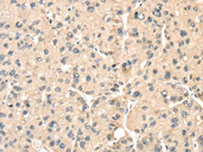 The image on the left is immunohistochemistry of paraffin-embedded Human liver cancer tissue using CSB-PA038096(LOXL3 Antibody) at dilution 1/35, on the right is treated with synthetic peptide. (Original magnification: ×200)