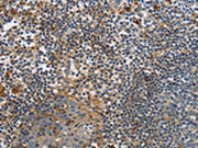 The image on the left is immunohistochemistry of paraffin-embedded Human tonsil tissue using CSB-PA038167(PAK4 Antibody) at dilution 1/20, on the right is treated with fusion protein. (Original magnification: ×200)