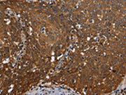 The image on the left is immunohistochemistry of paraffin-embedded Human cervical cancer tissue using CSB-PA038229(REL Antibody) at dilution 1/50, on the right is treated with fusion protein. (Original magnification: ×200)
