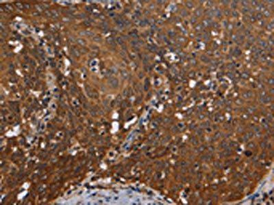 The image on the left is immunohistochemistry of paraffin-embedded Human cervical cancer tissue using CSB-PA038229(REL Antibody) at dilution 1/50, on the right is treated with fusion protein. (Original magnification: ×200)