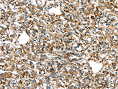 The image on the left is immunohistochemistry of paraffin-embedded Human prostate cancer tissue using CSB-PA038312(TGM4 Antibody) at dilution 1/20, on the right is treated with fusion protein. (Original magnification: ×200)