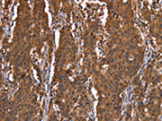 The image on the left is immunohistochemistry of paraffin-embedded Human gastic cancer tissue using CSB-PA038349(HINT1 Antibody) at dilution 1/30, on the right is treated with synthetic peptide. (Original magnification: ×200)