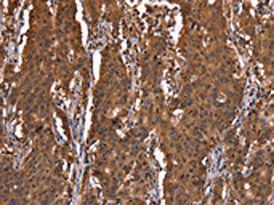 The image on the left is immunohistochemistry of paraffin-embedded Human gastic cancer tissue using CSB-PA038349(HINT1 Antibody) at dilution 1/30, on the right is treated with synthetic peptide. (Original magnification: ×200)