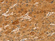 The image on the left is immunohistochemistry of paraffin-embedded Human liver cancer tissue using CSB-PA038458(STX2 Antibody) at dilution 1/50, on the right is treated with synthetic peptide. (Original magnification: ×200)