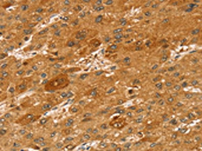The image on the left is immunohistochemistry of paraffin-embedded Human liver cancer tissue using CSB-PA038458(STX2 Antibody) at dilution 1/50, on the right is treated with synthetic peptide. (Original magnification: ×200)