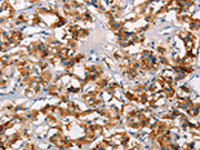 The image on the left is immunohistochemistry of paraffin-embedded Human thyroid cancer tissue using CSB-PA038897(SH2B2 Antibody) at dilution 1/15, on the right is treated with synthetic peptide. (Original magnification: ×200)