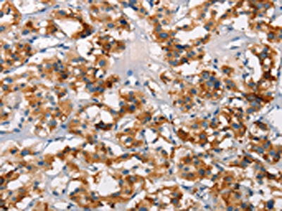 The image on the left is immunohistochemistry of paraffin-embedded Human thyroid cancer tissue using CSB-PA038897(SH2B2 Antibody) at dilution 1/15, on the right is treated with synthetic peptide. (Original magnification: ×200)