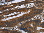 The image on the left is immunohistochemistry of paraffin-embedded Human colon cancer tissue using CSB-PA039047(ARHGEF12 Antibody) at dilution 1/30, on the right is treated with synthetic peptide. (Original magnification: ×200)