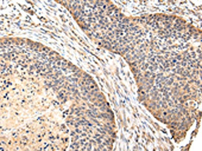 The image on the left is immunohistochemistry of paraffin-embedded Human esophagus cancer tissue using CSB-PA039084(VIL1 Antibody) at dilution 1/30, on the right is treated with fusion protein. (Original magnification: ×200)