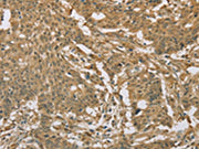The image on the left is immunohistochemistry of paraffin-embedded Human gastic cancer tissue using CSB-PA039162(EIF6 Antibody) at dilution 1/20, on the right is treated with fusion protein. (Original magnification: ×200)