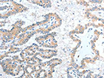The image on the left is immunohistochemistry of paraffin-embedded Human thyroid cancer tissue using CSB-PA039195(ADAM7 Antibody) at dilution 1/20, on the right is treated with fusion protein. (Original magnification: ×200)
