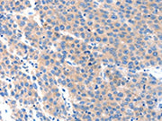 The image on the left is immunohistochemistry of paraffin-embedded Human liver cancer tissue using CSB-PA039286(KLK2 Antibody) at dilution 1/100, on the right is treated with synthetic peptide. (Original magnification: ×200)