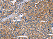 The image on the left is immunohistochemistry of paraffin-embedded Human liver cancer tissue using CSB-PA039310(CDC7 Antibody) at dilution 1/70, on the right is treated with synthetic peptide. (Original magnification: ×200)
