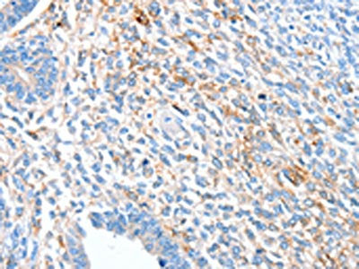 The image on the left is immunohistochemistry of paraffin-embedded Human ovarian cancer tissue using CSB-PA039662(ALDH1A2 Antibody) at dilution 1/60, on the right is treated with synthetic peptide. (Original magnification: ×200)