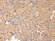 The image on the left is immunohistochemistry of paraffin-embedded Human liver cancer tissue using CSB-PA039740(CTSK Antibody) at dilution 1/20, on the right is treated with synthetic peptide. (Original magnification: ×200)