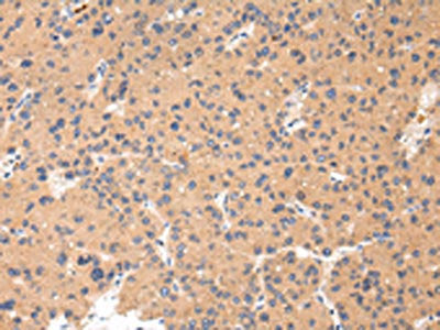 The image on the left is immunohistochemistry of paraffin-embedded Human liver cancer tissue using CSB-PA039740(CTSK Antibody) at dilution 1/20, on the right is treated with synthetic peptide. (Original magnification: ×200)