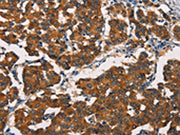 The image on the left is immunohistochemistry of paraffin-embedded Human breast cancer tissue using CSB-PA039805(ASIC1 Antibody) at dilution 1/20, on the right is treated with synthetic peptide. (Original magnification: ×200)