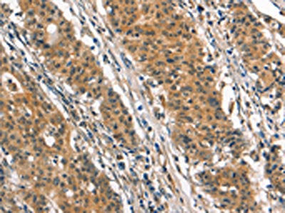 The image on the left is immunohistochemistry of paraffin-embedded Human gastic cancer tissue using CSB-PA039919(SMAD3 Antibody) at dilution 1/25, on the right is treated with synthetic peptide. (Original magnification: ×200)