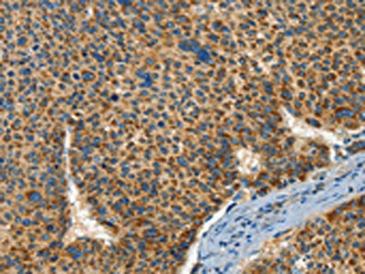 The image on the left is immunohistochemistry of paraffin-embedded Human liver cancer tissue using CSB-PA040376(IFT74 Antibody) at dilution 1/60, on the right is treated with synthetic peptide. (Original magnification: ×200)