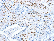 The image on the left is immunohistochemistry of paraffin-embedded Human lung cancer tissue using CSB-PA040400(ARID1A Antibody) at dilution 1/80, on the right is treated with synthetic peptide. (Original magnification: ×200)