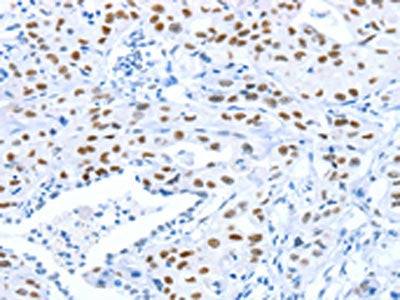 The image on the left is immunohistochemistry of paraffin-embedded Human lung cancer tissue using CSB-PA040400(ARID1A Antibody) at dilution 1/80, on the right is treated with synthetic peptide. (Original magnification: ×200)