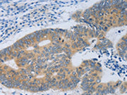 The image on the left is immunohistochemistry of paraffin-embedded Human colon cancer tissue using CSB-PA040452(MT2A Antibody) at dilution 1/40, on the right is treated with fusion protein. (Original magnification: ×200)