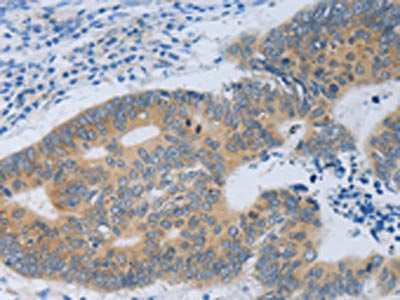 The image on the left is immunohistochemistry of paraffin-embedded Human colon cancer tissue using CSB-PA040452(MT2A Antibody) at dilution 1/40, on the right is treated with fusion protein. (Original magnification: ×200)