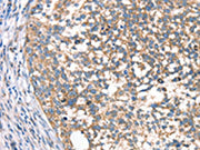 The image on the left is immunohistochemistry of paraffin-embedded Human cervical cancer tissue using CSB-PA040684(DECR1 Antibody) at dilution 1/40, on the right is treated with synthetic peptide. (Original magnification: ×200)