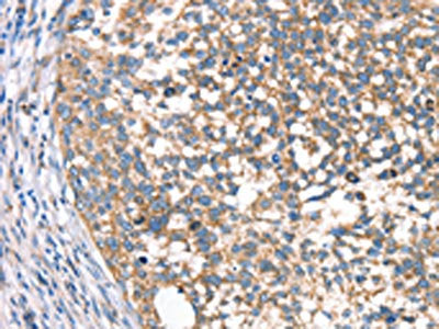 The image on the left is immunohistochemistry of paraffin-embedded Human cervical cancer tissue using CSB-PA040684(DECR1 Antibody) at dilution 1/40, on the right is treated with synthetic peptide. (Original magnification: ×200)