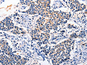 The image on the left is immunohistochemistry of paraffin-embedded Human breast cancer tissue using CSB-PA040885(RAB39A Antibody) at dilution 1/5, on the right is treated with synthetic peptide. (Original magnification: ×200)