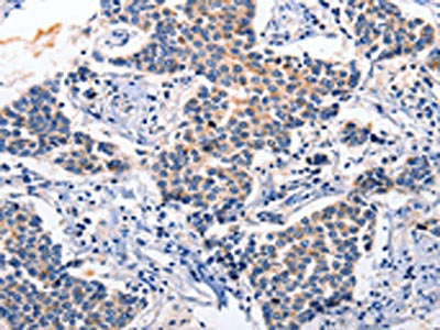 The image on the left is immunohistochemistry of paraffin-embedded Human breast cancer tissue using CSB-PA040885(RAB39A Antibody) at dilution 1/5, on the right is treated with synthetic peptide. (Original magnification: ×200)