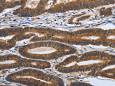 The image on the left is immunohistochemistry of paraffin-embedded Human colon cancer tissue using CSB-PA041073(PDGFA Antibody) at dilution 1/70, on the right is treated with synthetic peptide. (Original magnification: ×200)