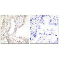 Immunohistochemical analysis of paraffin-embedded human lung carcinoma tissue using Prostate Apoptosis Response Protein-4 antibody.