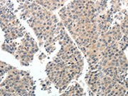 The image on the left is immunohistochemistry of paraffin-embedded Human liver cancer tissue using CSB-PA041300(TEK Antibody) at dilution 1/40, on the right is treated with synthetic peptide. (Original magnification: ×200)