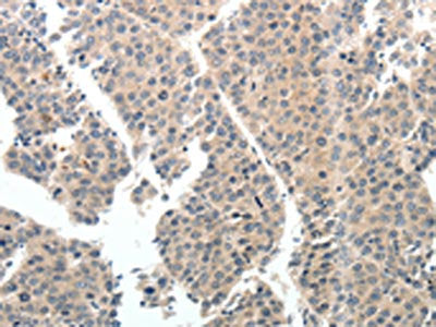 The image on the left is immunohistochemistry of paraffin-embedded Human liver cancer tissue using CSB-PA041300(TEK Antibody) at dilution 1/40, on the right is treated with synthetic peptide. (Original magnification: ×200)