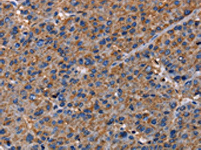 The image on the left is immunohistochemistry of paraffin-embedded Human liver cancer tissue using CSB-PA041313(NUP62 Antibody) at dilution 1/40, on the right is treated with fusion protein. (Original magnification: ×200)