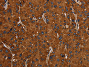 The image on the left is immunohistochemistry of paraffin-embedded Human liver cancer tissue using CSB-PA041473(SLC22A12 Antibody) at dilution 1/20, on the right is treated with synthetic peptide. (Original magnification: ×200)